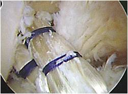 Double Bundle ACL Reconstruction