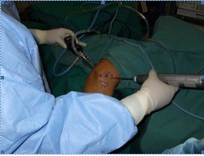 Elbow Arthroscopy