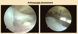 Supraspinatus Tendon Tear