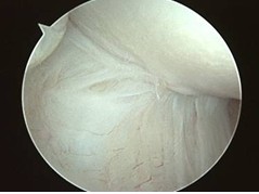 Type II Tennis Elbow Changes on Arthroscopy