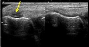 Ultrasound Scan of Tennis Elbow