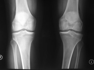 Chronic ACL Tear Left Knee