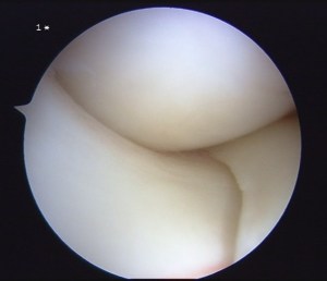 Medial Meniscus of the right knee