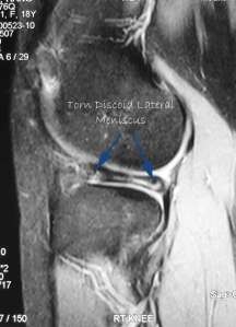 Torn Discoid Lateral Meniscus on MRI
