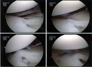 Repairing of the Discoid Meniscus to Capsule