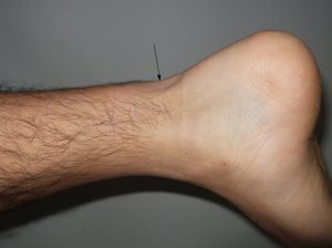 Achilles Tendon Rupture with Gap Seen