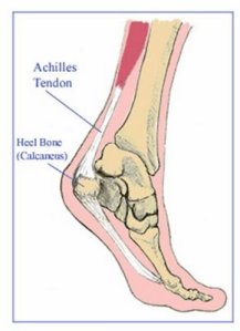 Achilles Tendon