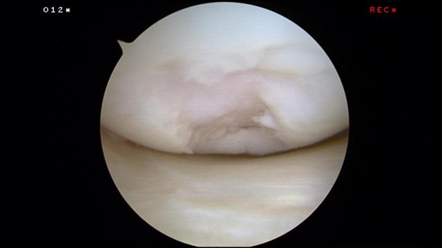 Cartilage Defect of the Knee