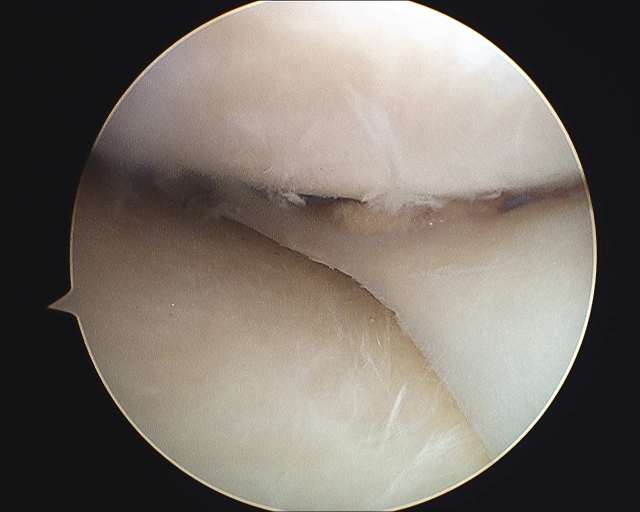 Medial Meniscus Transplant