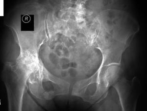 Osteoarthritis of the Right Hip
