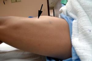 Rectus Femoris Rupture