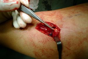 Rectus Femoris Rupture Intra-op