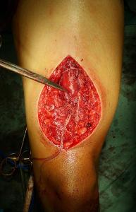 Repair of Rectus Femoris Rupture