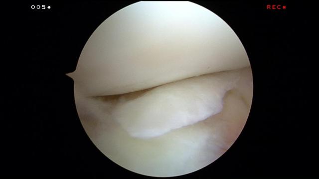 Torn cartilage inside the knee