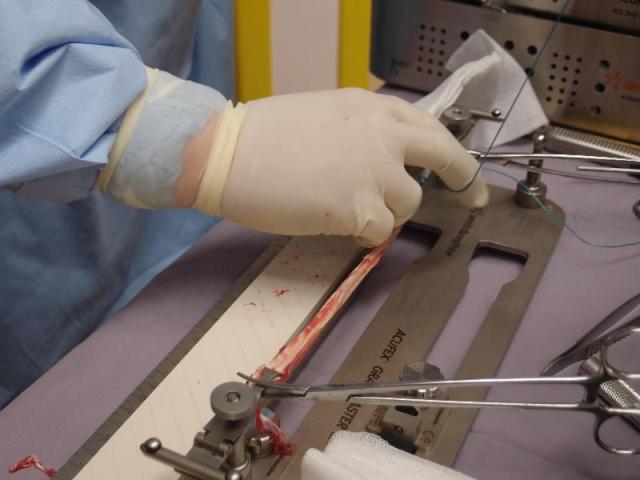 Preparing the Hamstring grafts