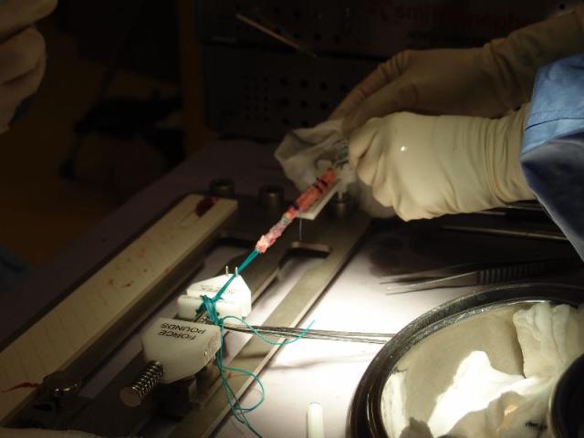 Grafts looped over endobutton and pre-tensioned