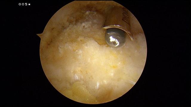 Burring away the Haglund's exostosis