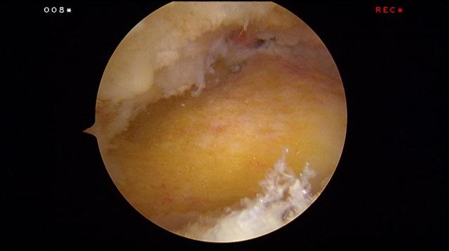 Completion of Removal of Haglund's exostosis