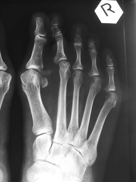  X-rays of Right Hallux Valgus