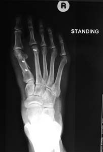  Post-op x-rays AP Standing