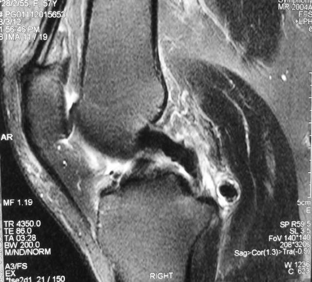 Loose Body of Knee MRI - HC Chang