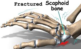 Fall on the outstretched hand resulting in scaphoid fracture