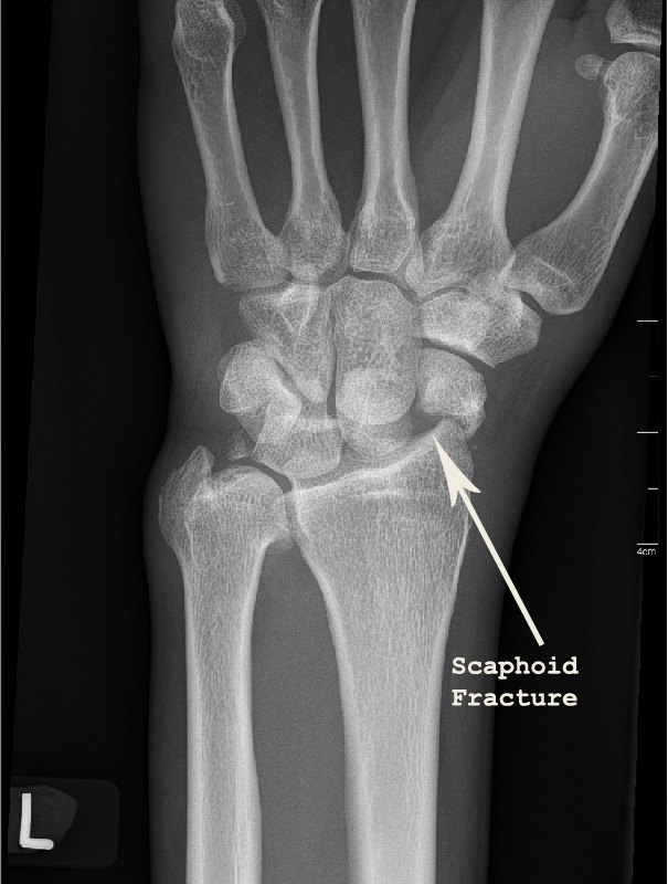 There is a fracture of the scaphoid waist.