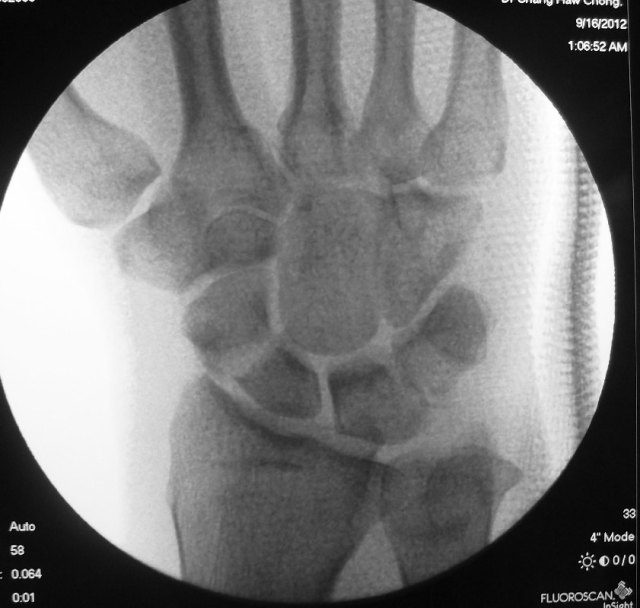 04 - Post-reduction AP HC Chang