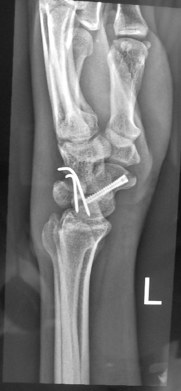 Trans-scaphoid perilunate ORIF