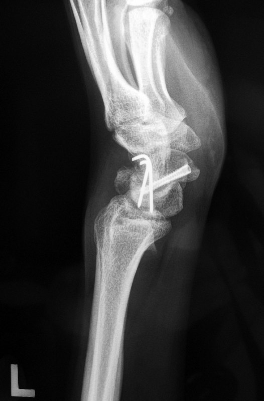 Healed scaphoid fracture