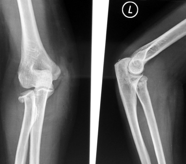 Radial Head Fracture