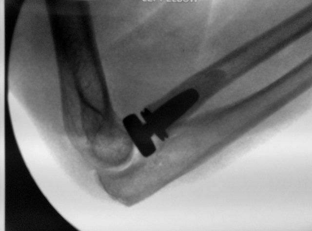 Radial Head Replacement X-ray