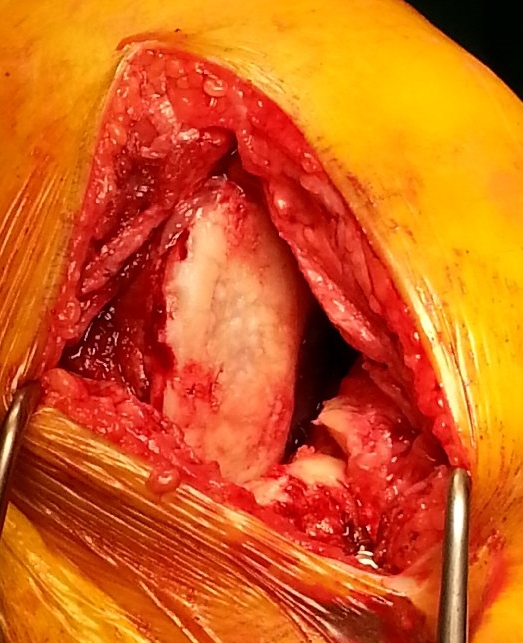 medial compartment arthritis