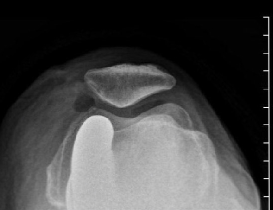 Makoplasty by Dr HC Chang - Check X-rays Skyline