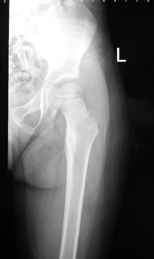 02 - Osteoid Osteoma X-rays by Dr HC Chang