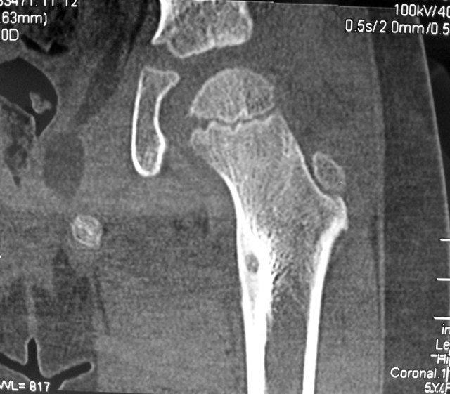 CT-scan shows a nidus of Osteoid Osteoma in the Lesser Trochanter of the Left Hip Joint