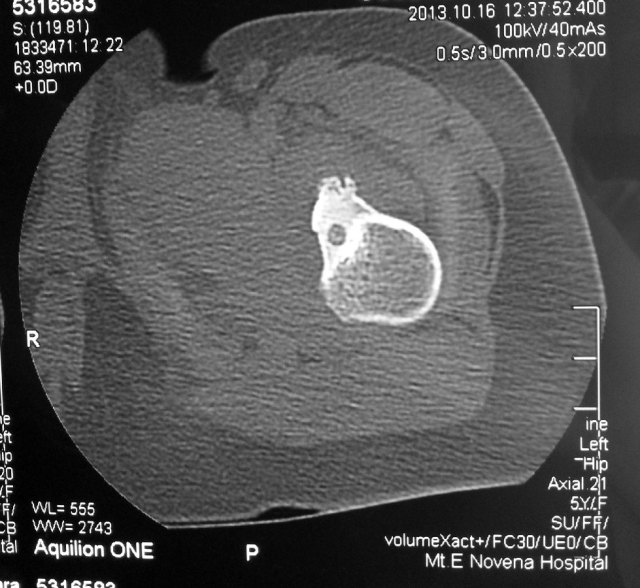 05 - Osteoid Osteoma CT-scan by Dr HC Chang