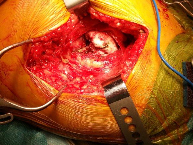 Exposure of the Hip Joint