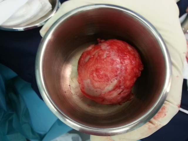 AVN Femoral Head Left Hip