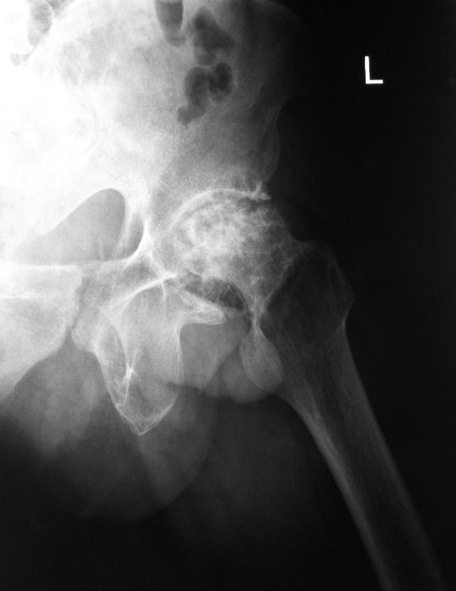 AVN Hip | HC Chang Orthopaedic Surgery