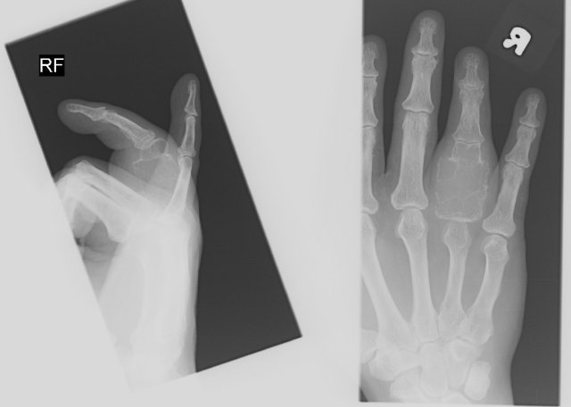 Bony Tumour of Right Ring Finger Proximal Phalanx