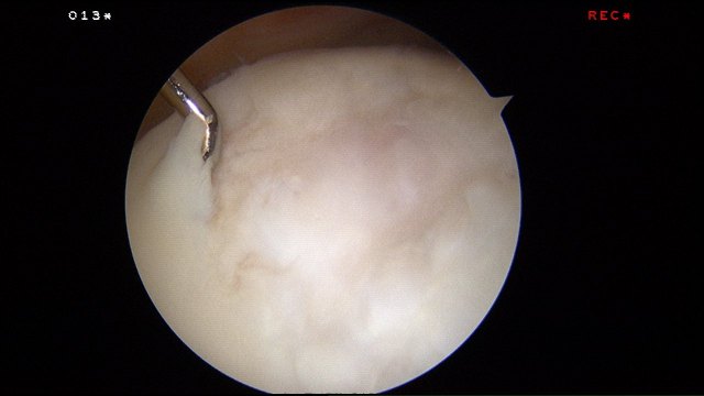 Full thickness cartilage loss in the femoral trochlear groove