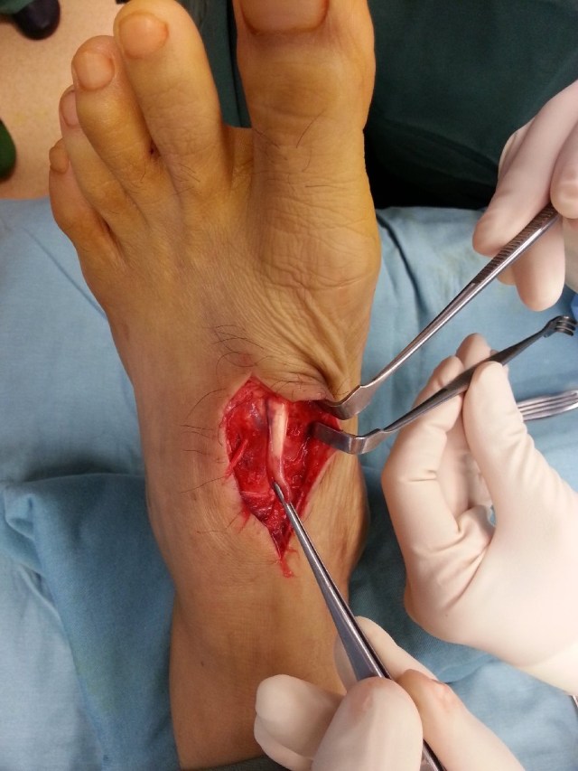 Completely lacerated extensor hallucis longus tendon to the left big toe.