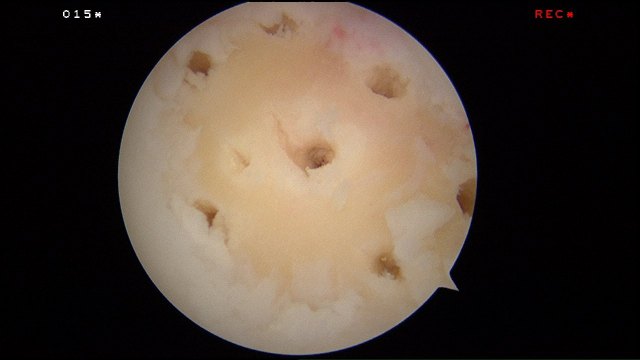 Microfracture performed