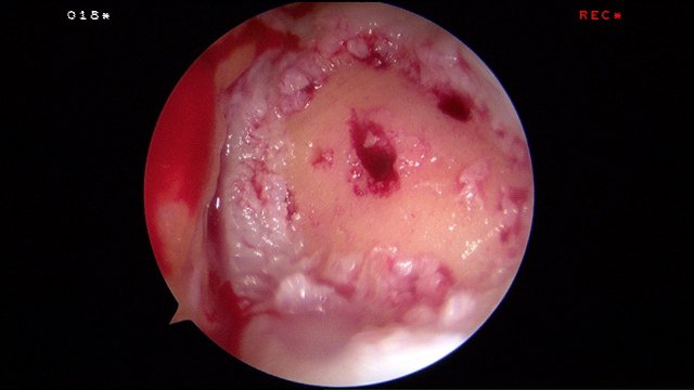 The tourniquet is released to check for bleeding from the microfracture pits.