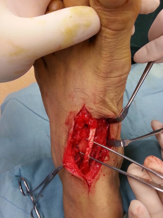 The cut extensor tendon was repaired using looped supramid sutures