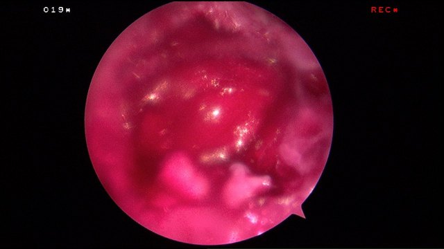 Hyalofast scaffold applied over the cartilage defect.