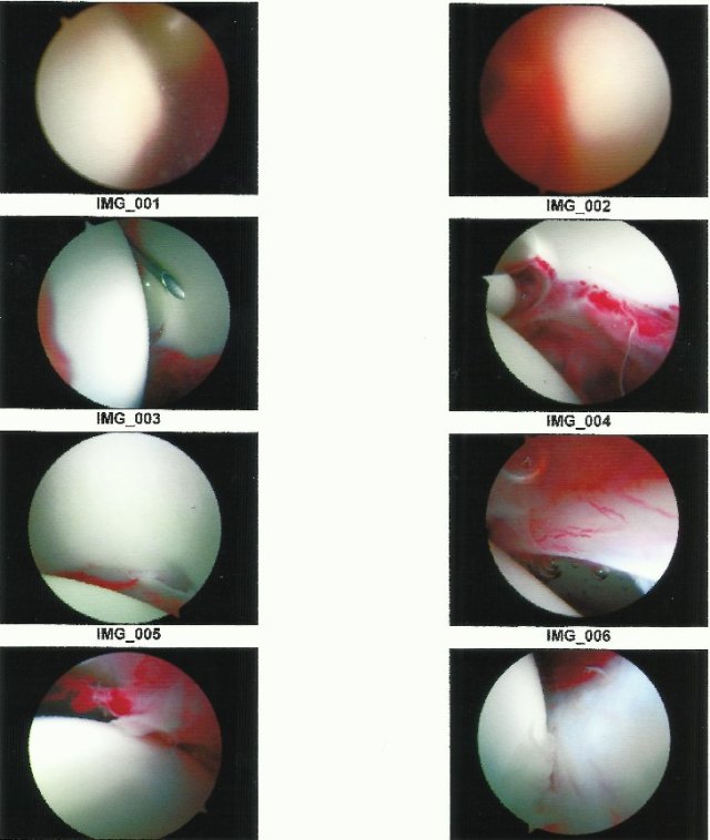 08 - Hip Arthroscopy