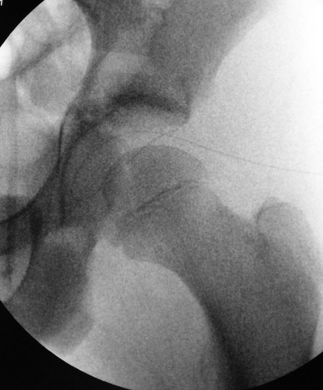 Drain inside the left hip joint.