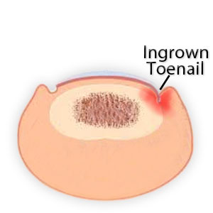 ingrown toenail picture